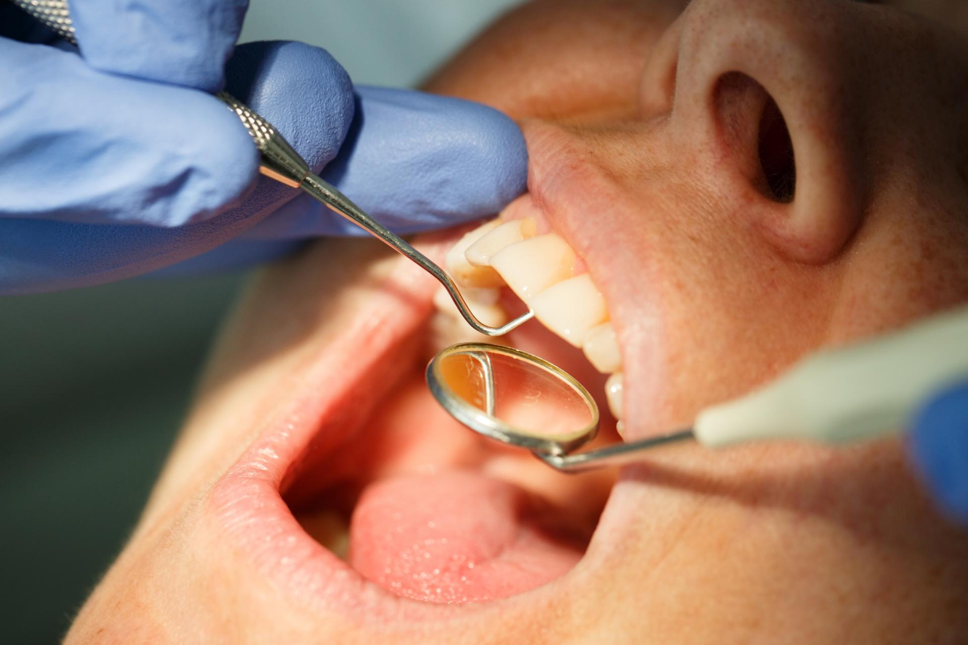 Boca abierta siendo revisada pro el dentista